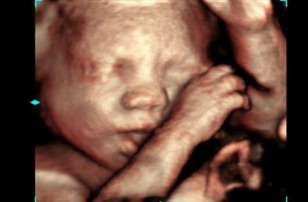 Рис.1.  Внутриутробное 3D УЗИ, видна голова, плечи и ручки ребенка.