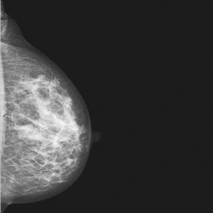 Рис.2: Здоровая ткань груди как она выглядит на маммограмме.
