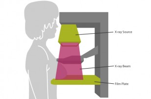 Рис. 1: При маммографии каждая грудь прижимается горизонтально, а потом наклонно, при этом делается снимок в каждой позиции.