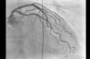 Рис. 2: Ангиограмма кровеносных сосудов в области сердца с низкой дозой облучения.